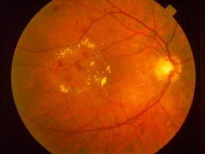 Diabetic Retinopathy