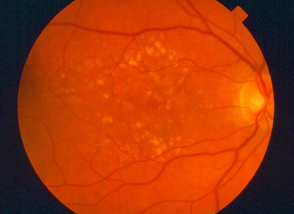 Dry amd