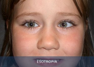 esotropia-copy