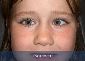 Ohio Eye Alliance Pediatric Ophthalmology And Adult Strabismus Ohio Eye Alliance