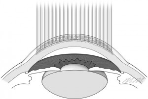 LASIK Process