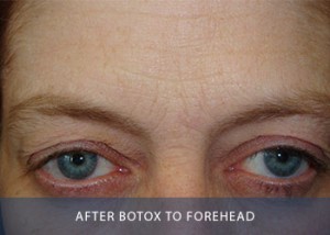 botox-a-after