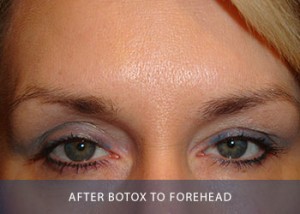 botox-b-after