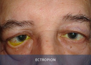 ectropion