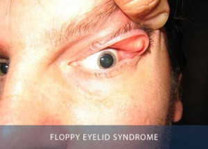 floppy-eyelid
