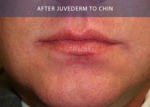 juvederm-chin-after