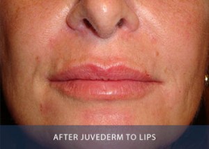 juvederm-lips-after