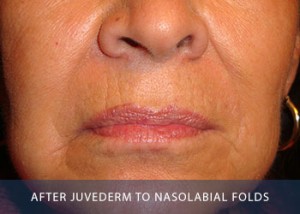 nasolabial-after