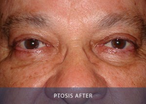 ptosis-after
