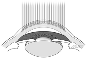 Lasik process example