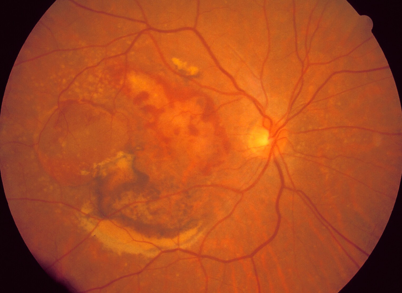 how macular degeneration forms