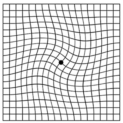 Macular-Degeneration-Vision figure